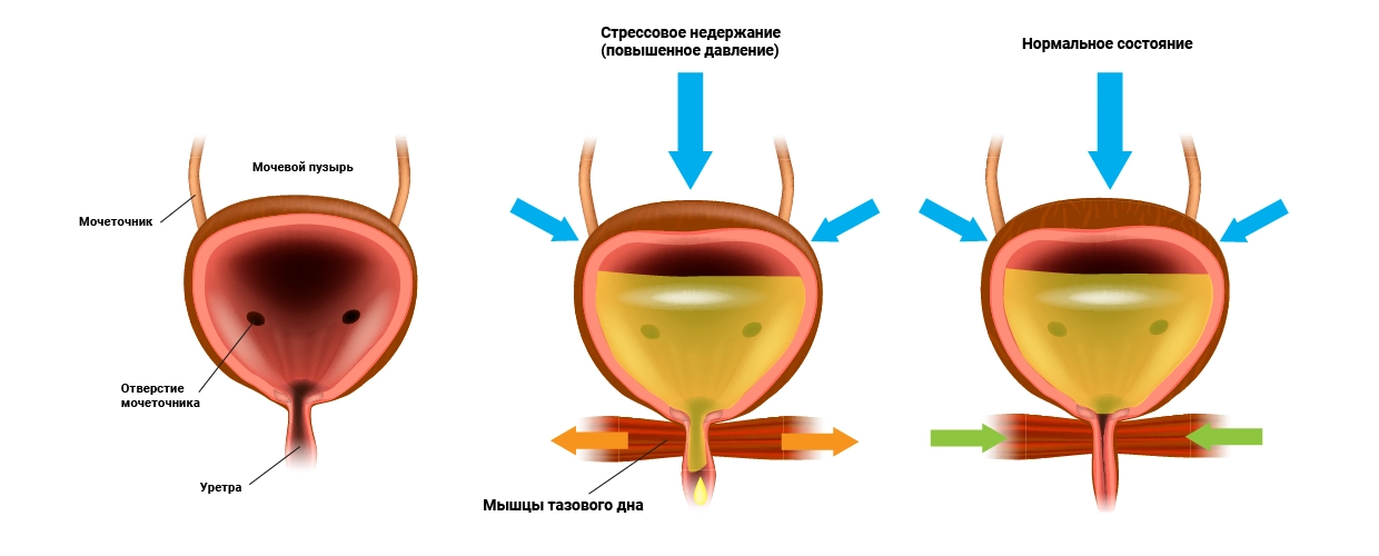 Классификация детского энуреза